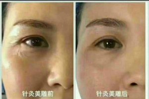 针灸美容美雕针面针