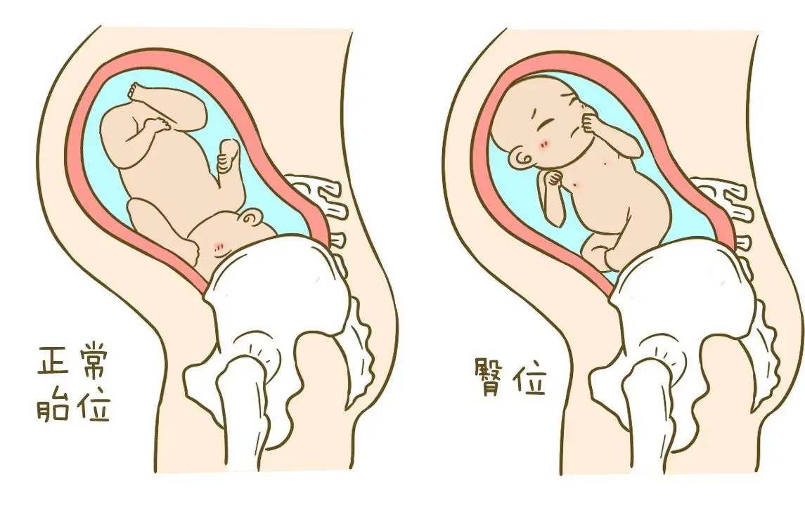 什么是胎位臀位？胎位臀位是睡太多的原因吗?插图
