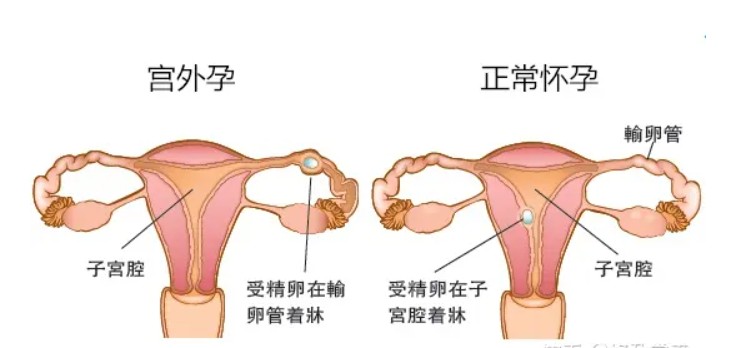 怀孕4个月怎么从胎动看男女？ 宫外孕试纸能测出吗？插图2