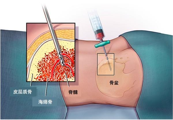 穿刺活检会促使肺癌转移吗？ 为什么有的人吸烟一辈子却没得肺癌？插图