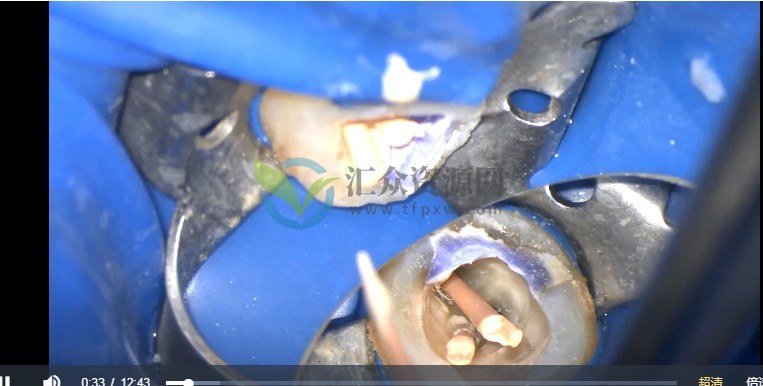 热牙胶充填视频教程插图