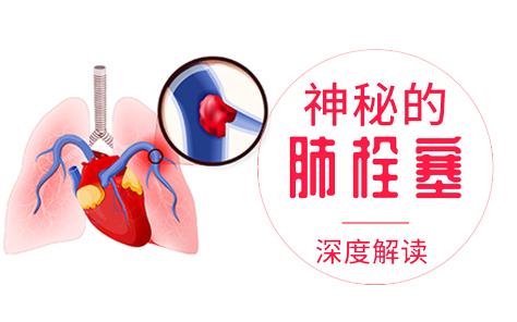 确诊肺栓塞 神秘的急性肺栓塞深度解读